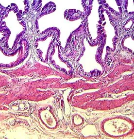 vesicae biliaris