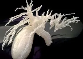 vesicae biliaris