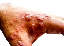 herpes zoster