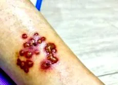 herpes zoster