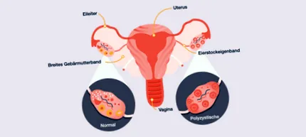 pcos
