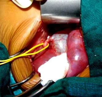 ureterális