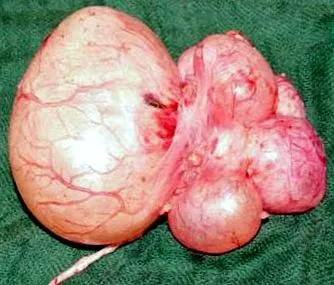 hydronephrosis