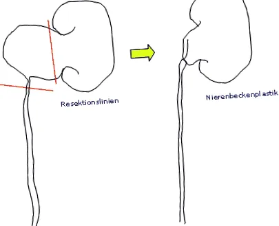 ureterális