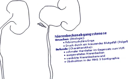 hydronephrosis