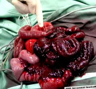 ischaemia
