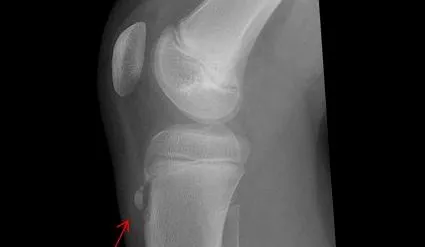 osgood-schlatter