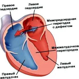 infarktus