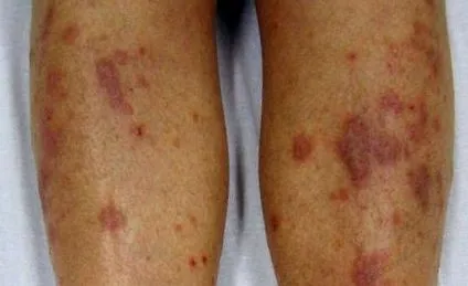 lichen planus