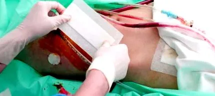 transplanturile