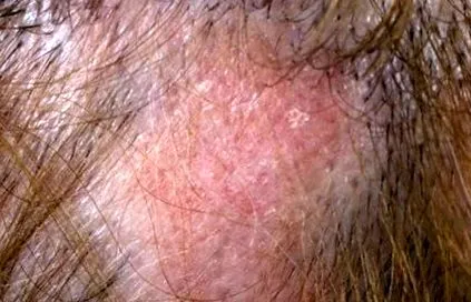 lupus