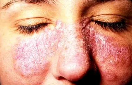 lupus