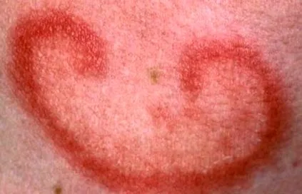 lupus