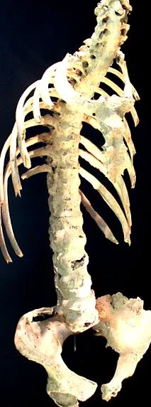 spondylitis bechterew-kór