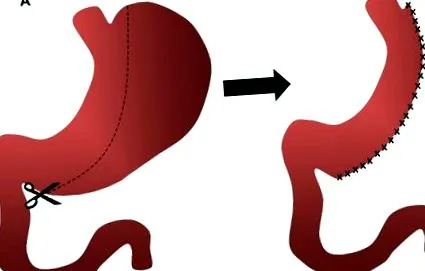 gastrectomie