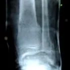 osteoporosis