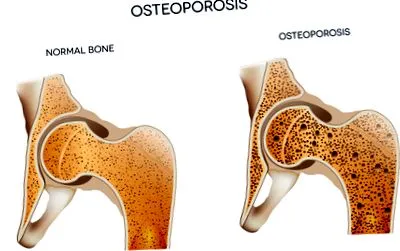 osteoporosis