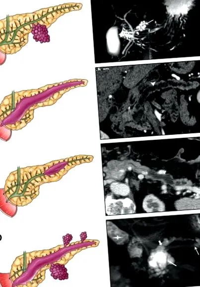 pancreatice toate acestea