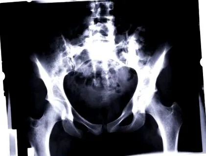 osteoporosis