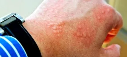 allergia