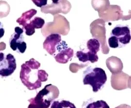 pyoderma