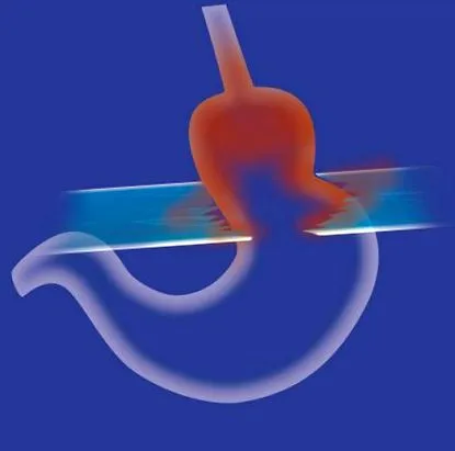 reflux