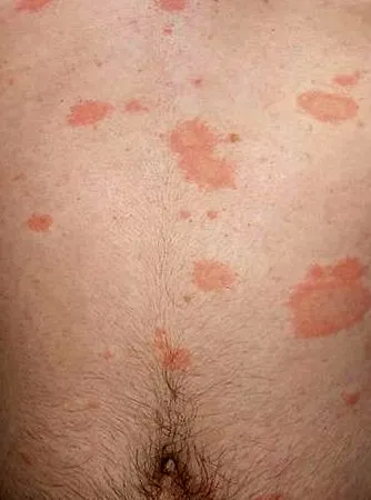pityriasis