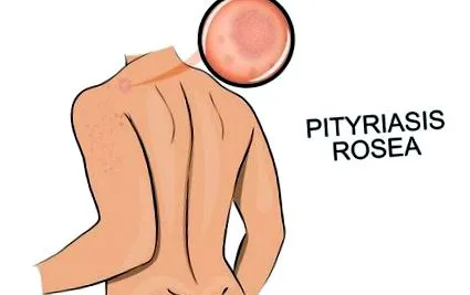 pityriasis