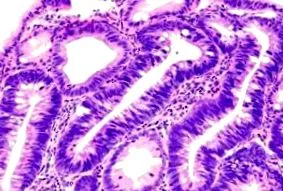 adenomului simptomele