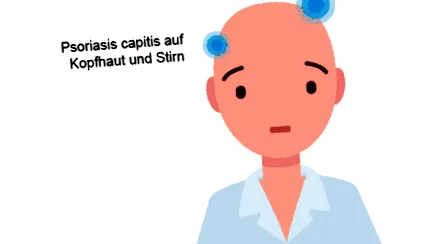 psoriazis