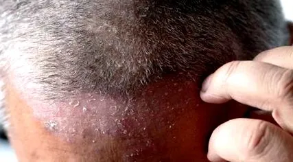 scalp
