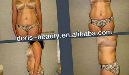 elhízás