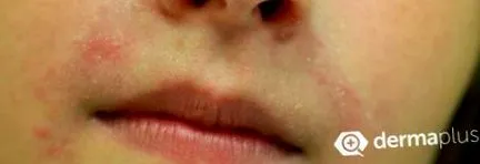 gyermekek allergiás