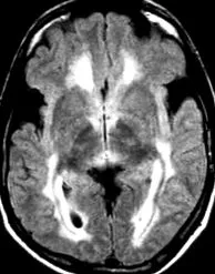 vestibulitis