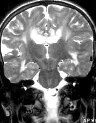 macrocephaly