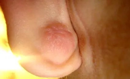 angiolipoma