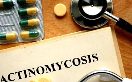 actinomycosisról