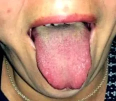 limbii