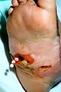 antibiotic