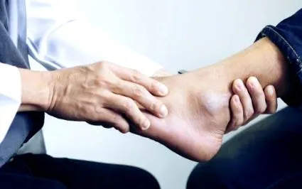 osteoartrita