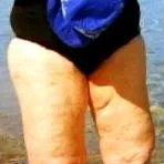 teljes cellulit