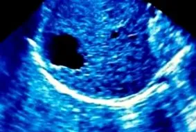 hepatitei