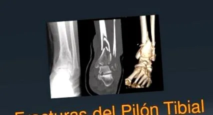 tibial