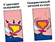 жени дијагноза