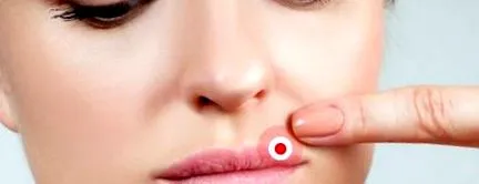 herpes