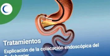 Endobarrier ново лечение