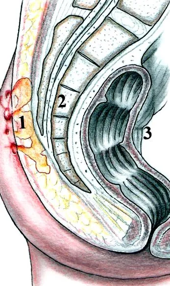 cyst