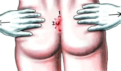 pilonidal