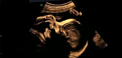 prenatal