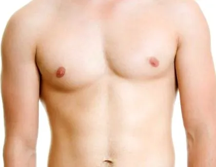 gynecomastia